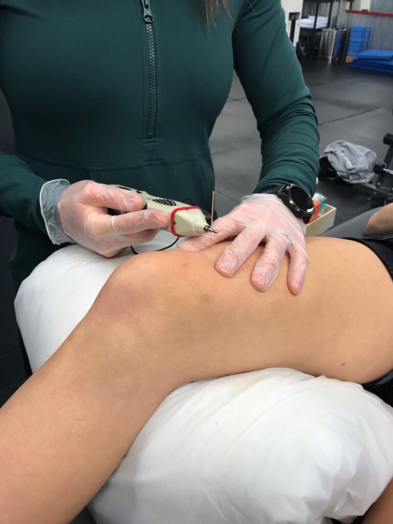 Dry needle therapy at Live Active Physiotherapy